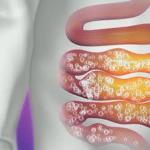 How to get rid of gases in the intestines
