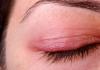 Chr blepharitis.  בלפריטיס של העין.  האם בלפריטיס מדבק או לא?