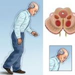 Parkinson's disease: symptoms and signs in women and men What is a Parkinson's mask