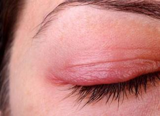 Chr blepharitis.  Blepharitis of the eye.  Is blepharitis contagious or not?